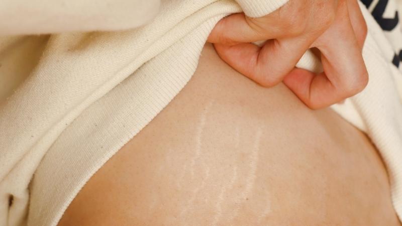 Rau má giúp làm mờ các vḗt rạn ở da nhờ vào hoạt tính của triterpenoid