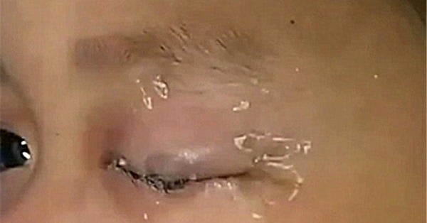 Cậu bé Tiểu Minh khóc thét vì bị keo 502 bắn vào mắt - Ảnh minh họa