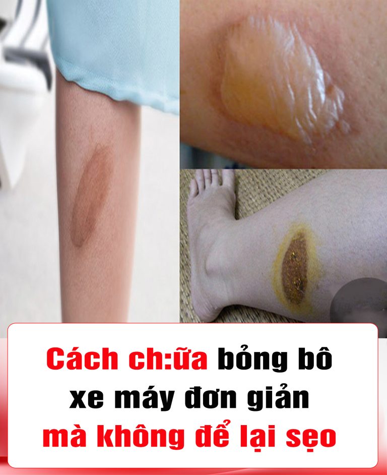 Bỏng bô xe máy, làm ngay cách này để nhanh lành vết thương và chống bị sẹo xấu