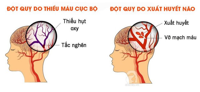 Có nhiều nguyên nhân dẫn tới đột quỵ.