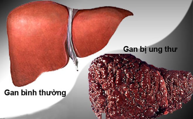 phuong-phap-phat-hien-som-ung-thu-gan-khong-sinh-thiet-1507629941357-13-0-447-700-crop-1507629945459