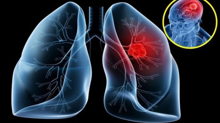 9 dấu hiệu ung thư phổi giai đoạn đầu, đừng lơ là kẻo di căn nguy hiểm