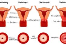 Người vợ 38 tuổi bị UT cổ tử cung vì chiều theo “sở thích” của chồng: Dù yêu chồng đến mấy vẫn cần tỉnh táo