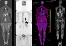 Mắc ungthư giai đoạn cuối di căn não, người phụ nữ đi khám, òa khóc khi biết “thủ phạm” đến từ chồng con