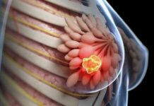 8 kiểu phụ nữ dễ bị K v:ú nhất: Xem bạn có trong số đó?